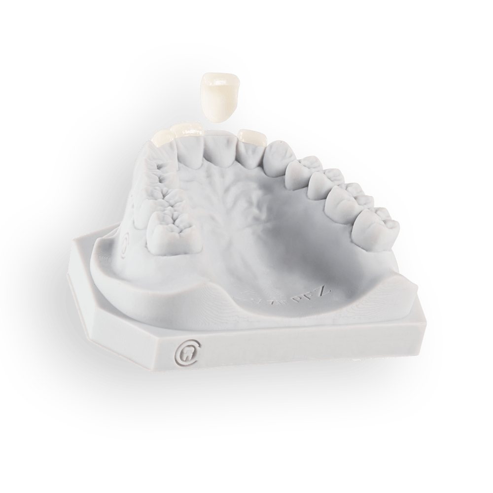 Veneers