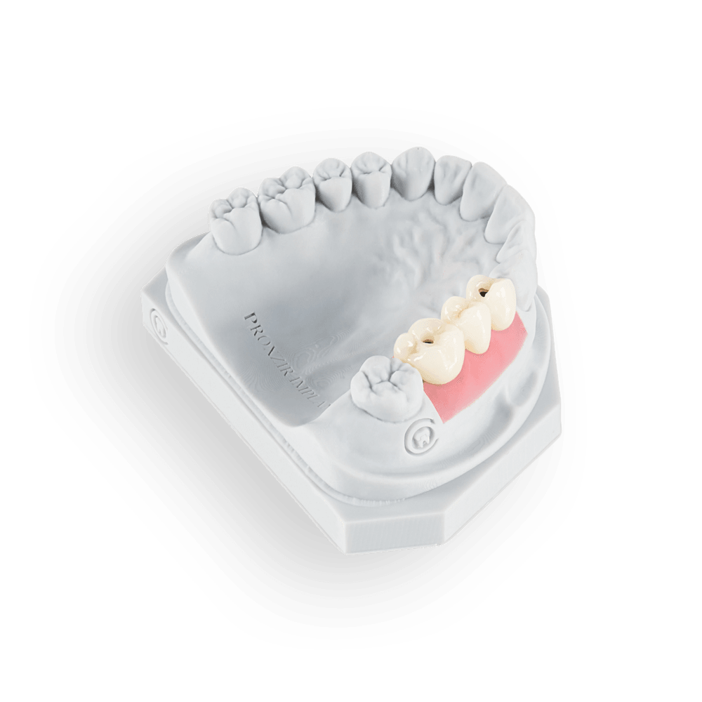Screw Retained implant restoration