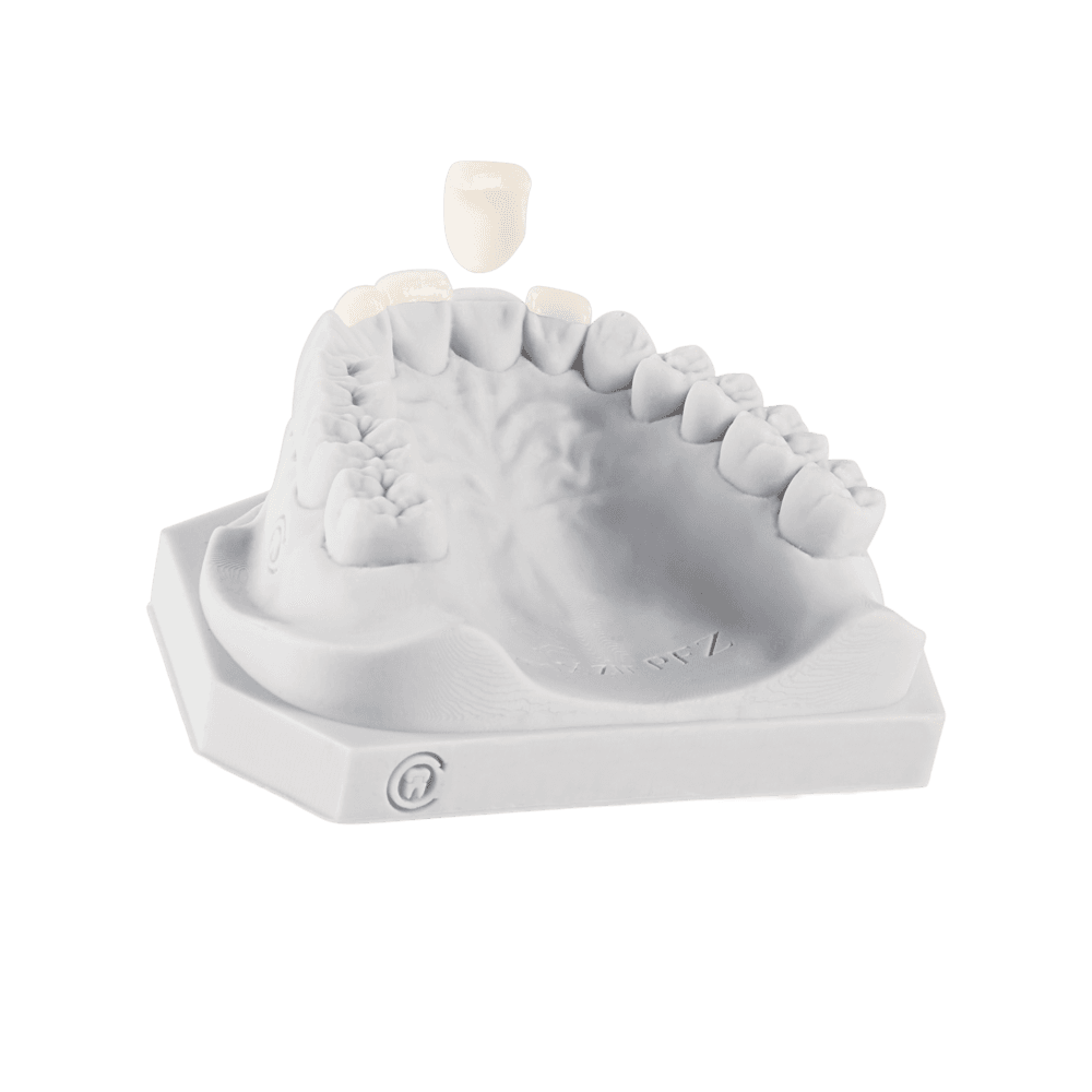 Porcelain veneers