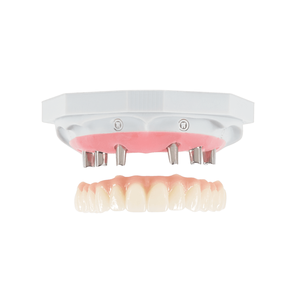 Screw-retained implant restoration