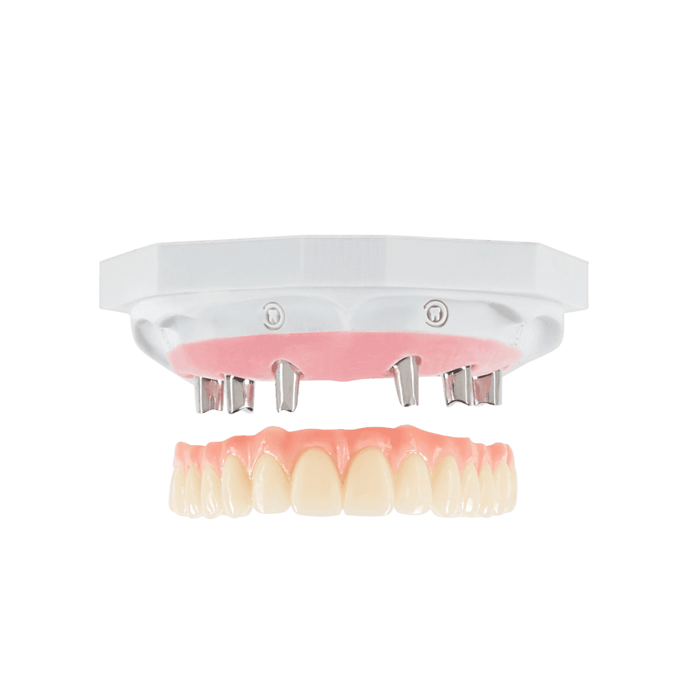 NeoPrep restoration