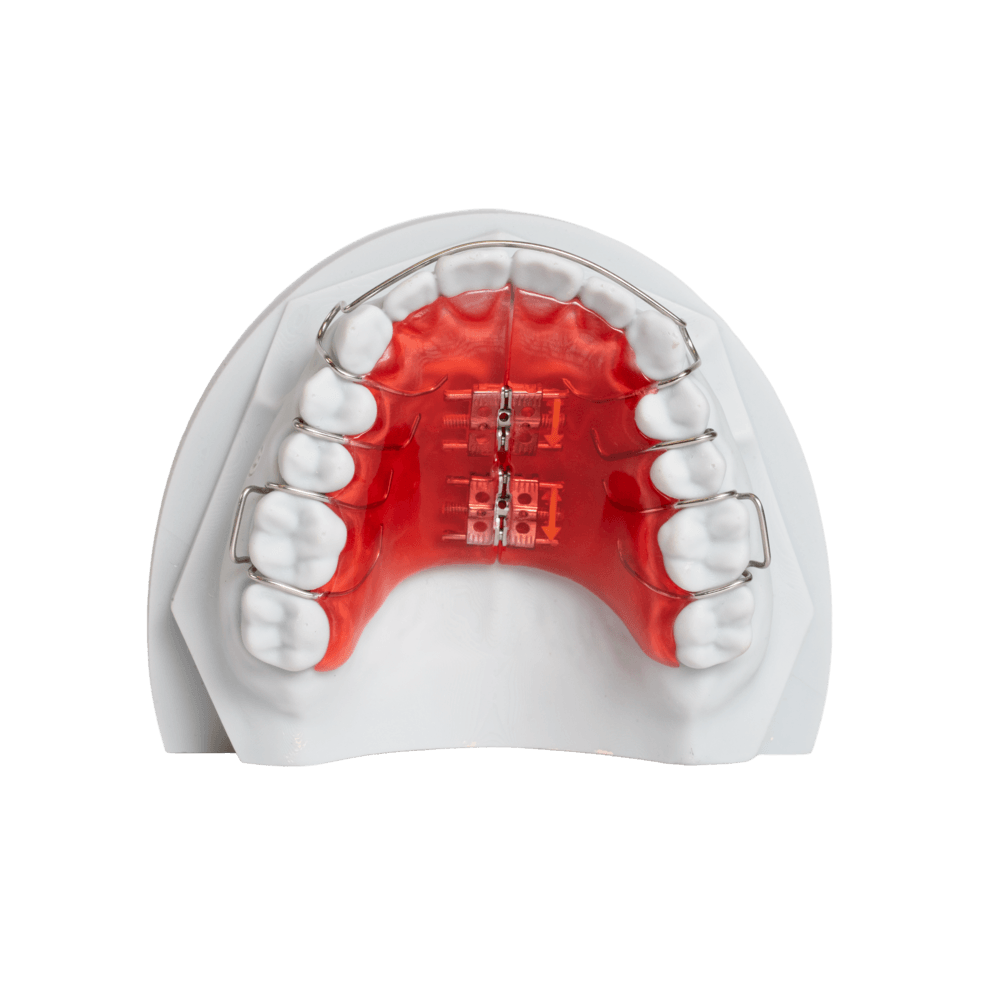 Palatal Expanders